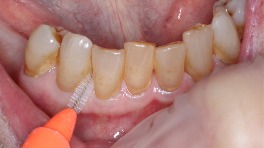 En mellemrumstandbørste.